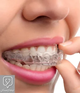 Open bite treatment with clear orthodontics