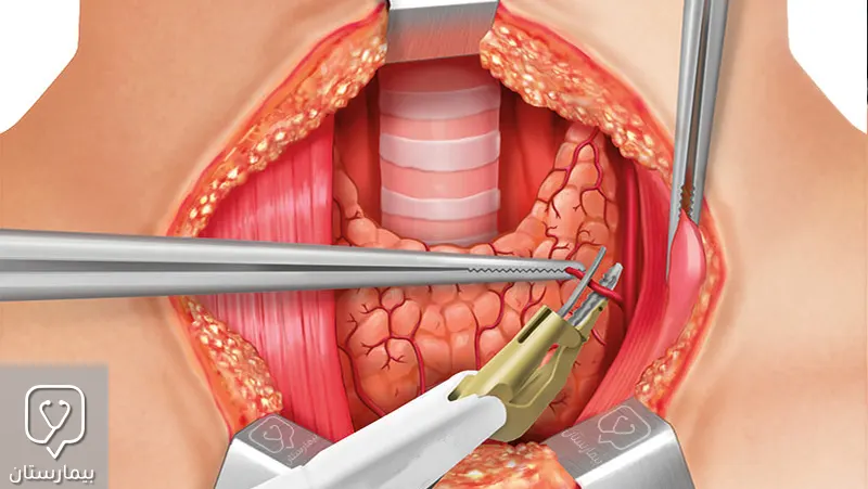 Conventional thyroidectomy