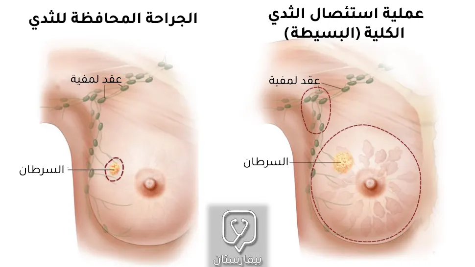 عملية استئصال الثدي بالكامل مقابل الجراحة المحافظة للثدي