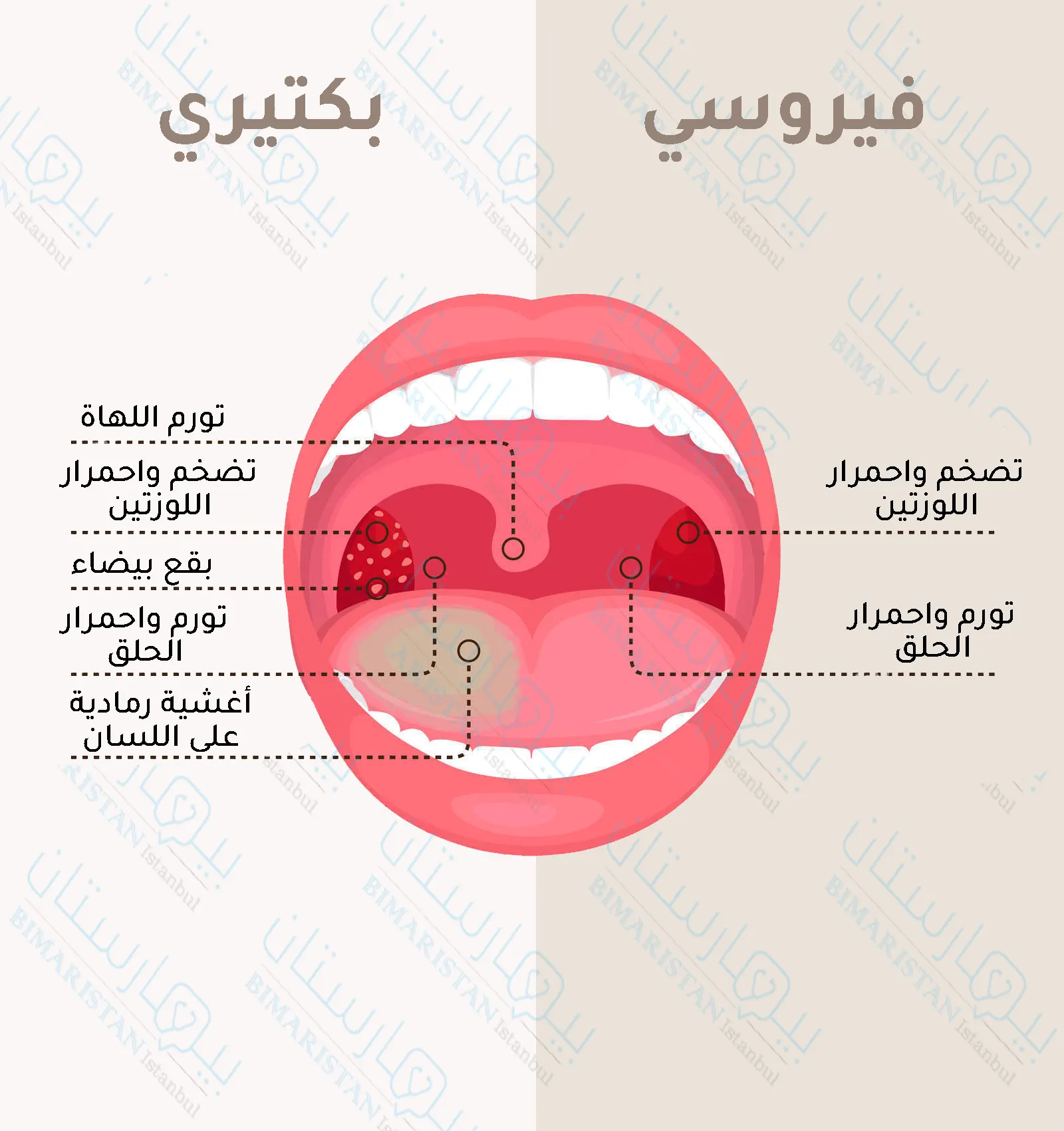 Causes of tonsillitis in children | The difference between bacterial tonsillitis and viral tonsillitis