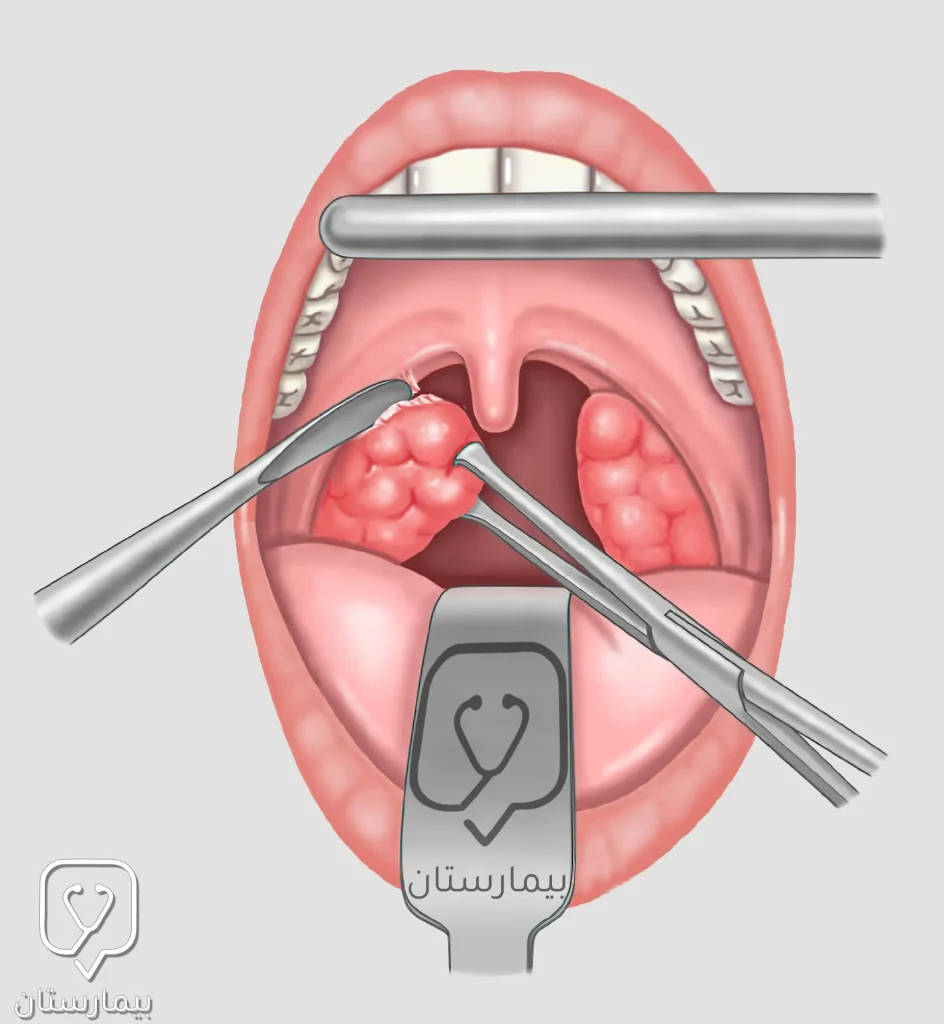 In a tonsillectomy, the surgeon removes the enlarged tonsils from the adjacent tonsils