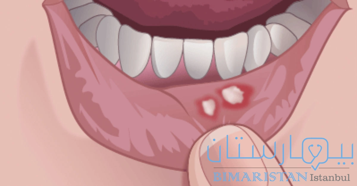 Mouth ulcers on the lip