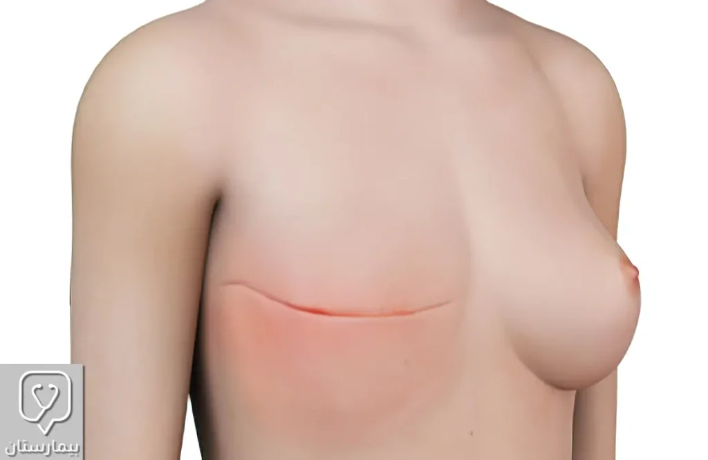 The chest of a patient with breast cancer who underwent a total mastectomy