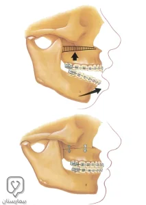 Surgical treatment of open bite