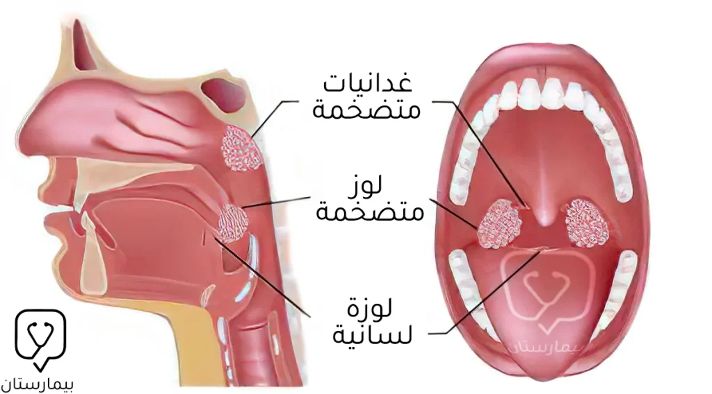 Enlargement of the tonsils is often associated with enlarged adenoids.