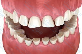 Diş gıcırdatma tedavisi