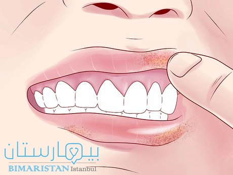 آفات الفم السرطانية على الشفة