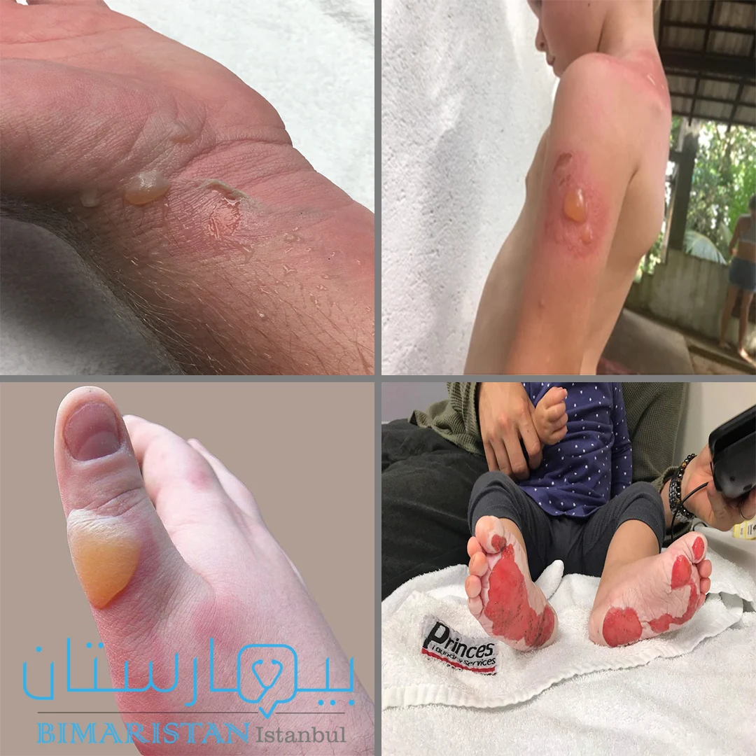 Pictures of second-degree burns, usually blistering or exfoliating