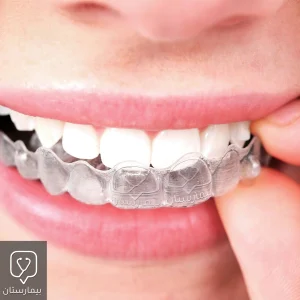Deep bite treatment with clear braces