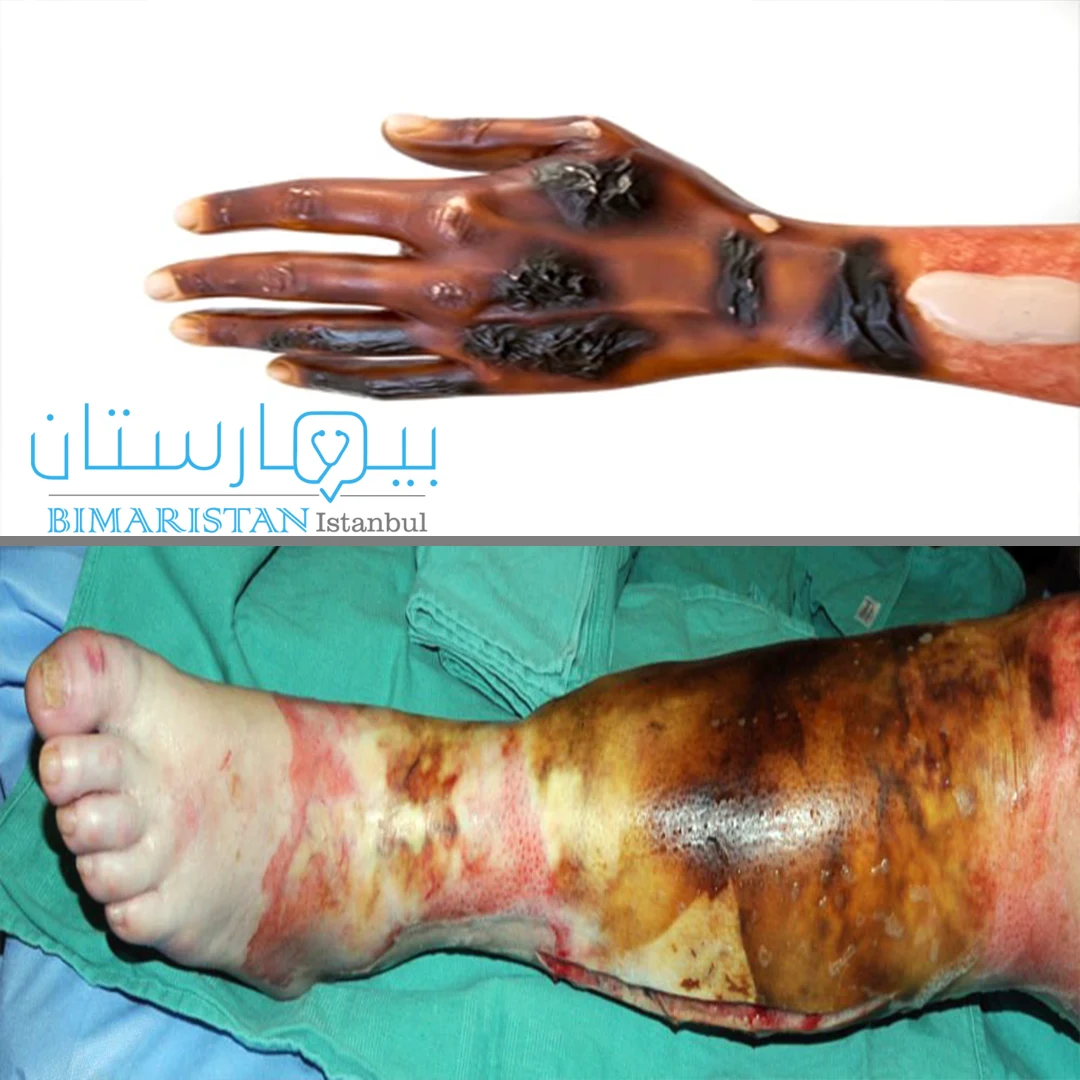 Pictures of third-degree burns showing the black color of the burn