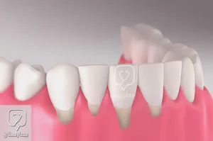 Treatment of receding gums and receding gums