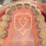Treatment of deep bite with lingual orthodontics
