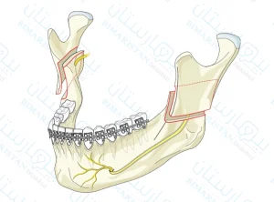 علاج تراجع الفك السفلي بجراحة Bsso في تركيا