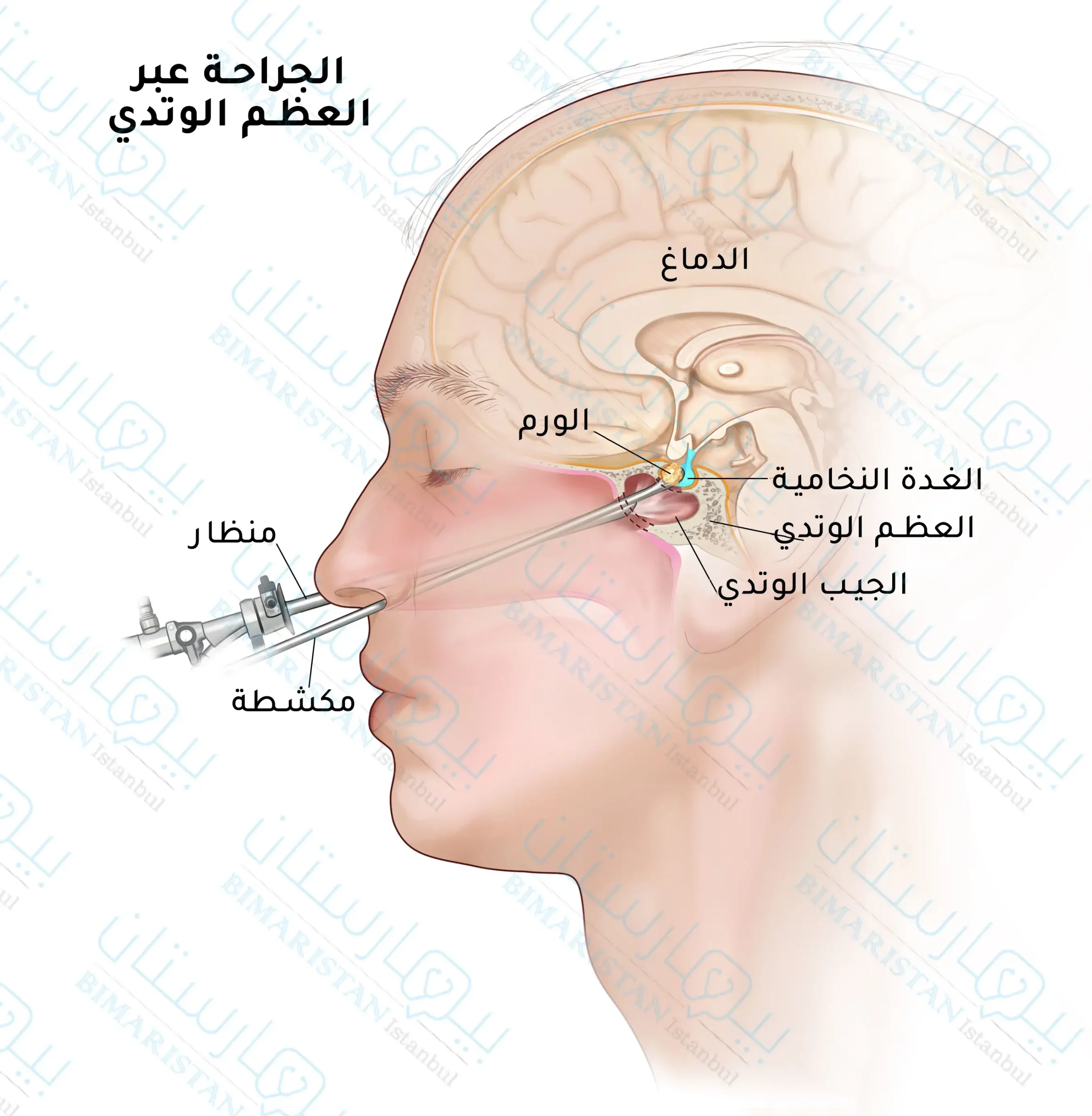 Treatment of pituitary tumor by surgery through the sphenoid bone