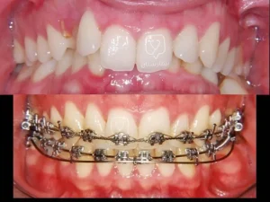 Orthodontic deep bite treatment