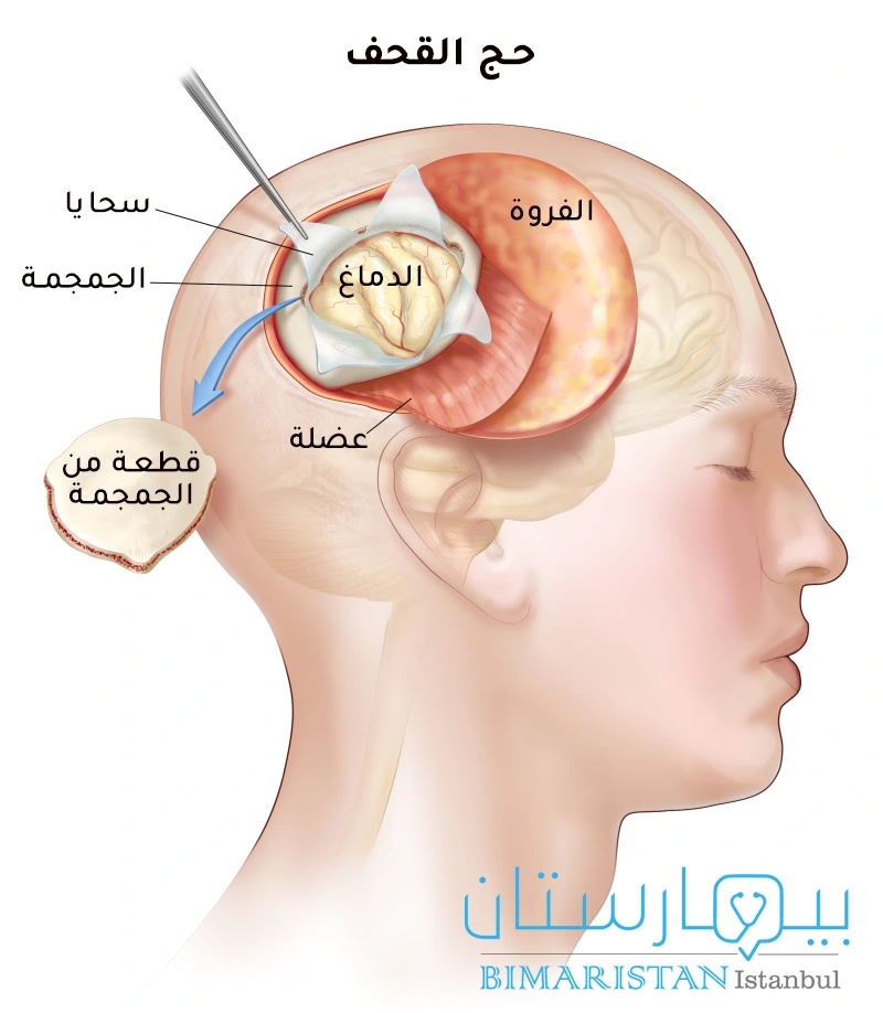 Treatment of pituitary tumor by transcranial surgery