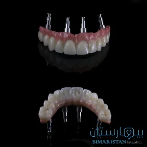 An implant-supported denture stays securely in place even while chewing and speaking
