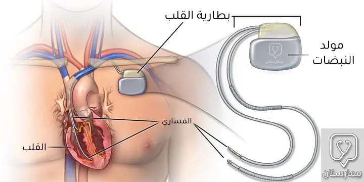 Pacemaker components
