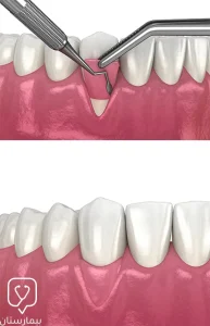 Gum implantation process