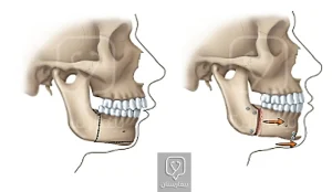 Orthognathic treatment of deep bite