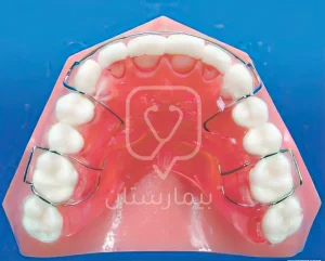 Stabilization devices after orthodontic deep bite treatment