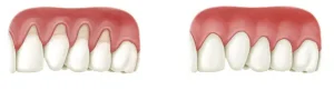 Gum implantation process