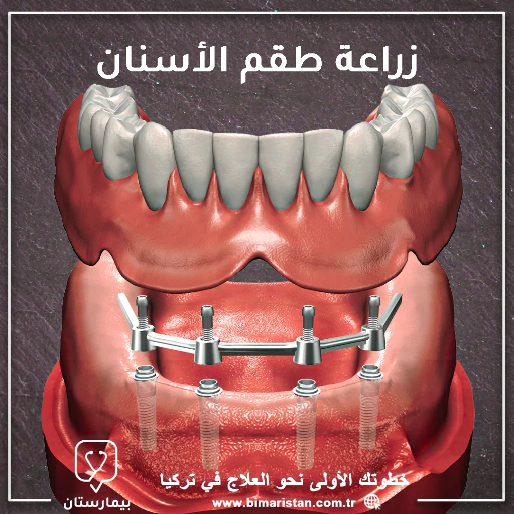 Implant-set-teeth-complete