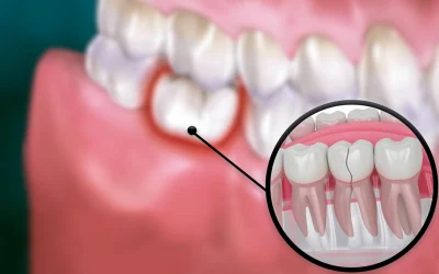 All you need to know about treating a broken tooth