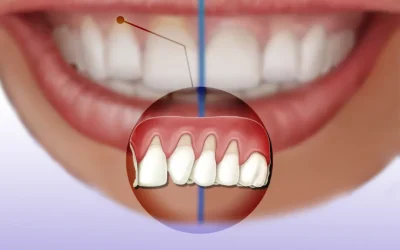 Gum transplantation to treat receding gums
