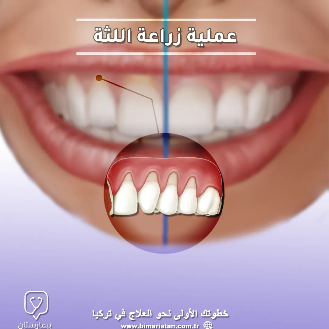 periodontal-implant-operation