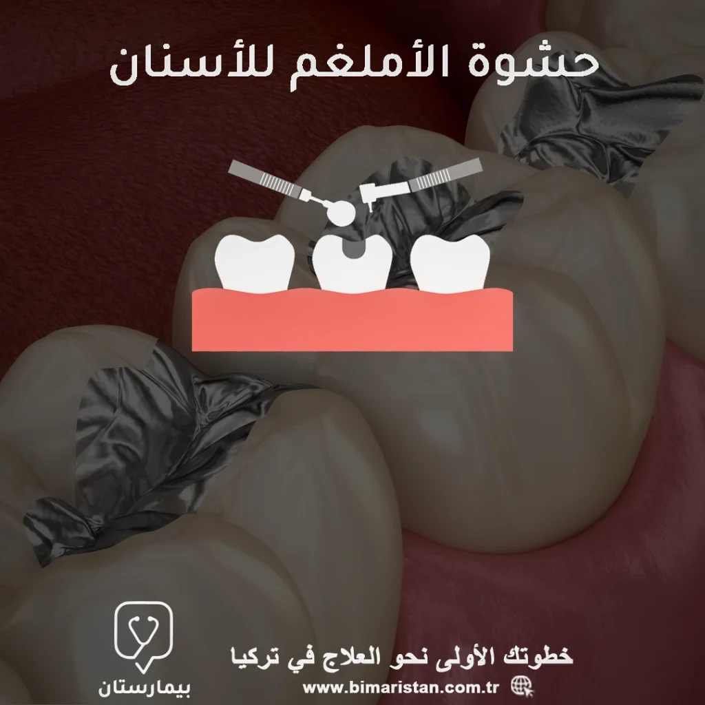 Dental amalgam fillings