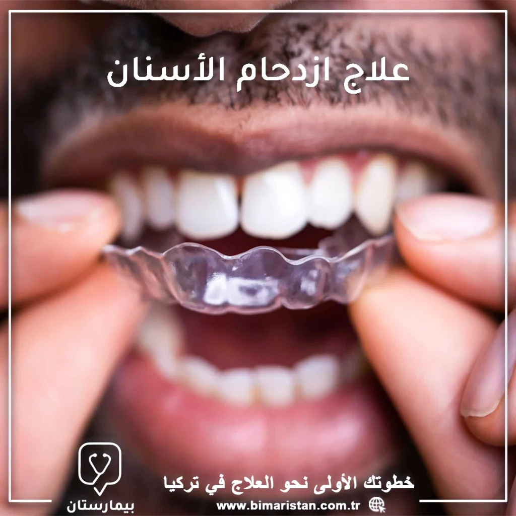 علاج ازدحام الأسنان في تركيا