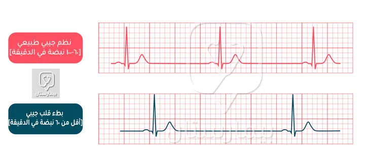 The difference between a normal electrocardiogram and a sinus bradycardia