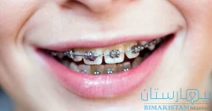 Geleneksel metal diş telleri ile diş patlaması tedavisi