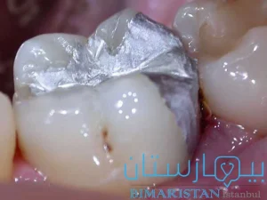 Dental amalgam filling