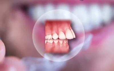 علاج بروز الأسنان بالتقويم الشفاف