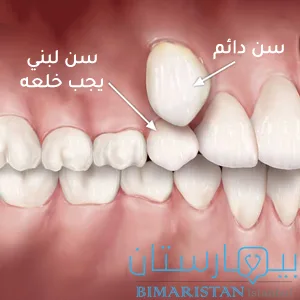 A remaining temporary tooth that must be extracted to make room for the eruption of the permanent tooth