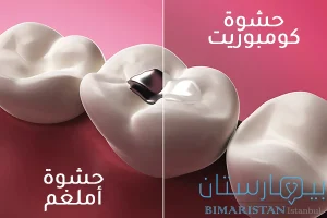 Dental amalgam fillings