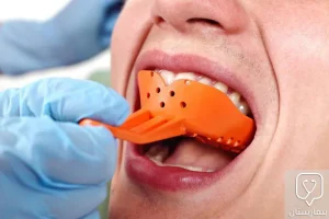 Traditional dental impressions