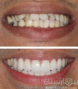 Türkiye'de diş çapraşıklığı tedavisi