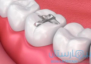 Dental amalgam filling