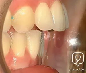 علاج بروز الأسنان