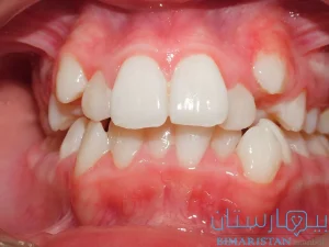 علاج ازدحام الأسنان
