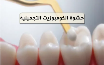 All you need to know about cosmetic composite fillings