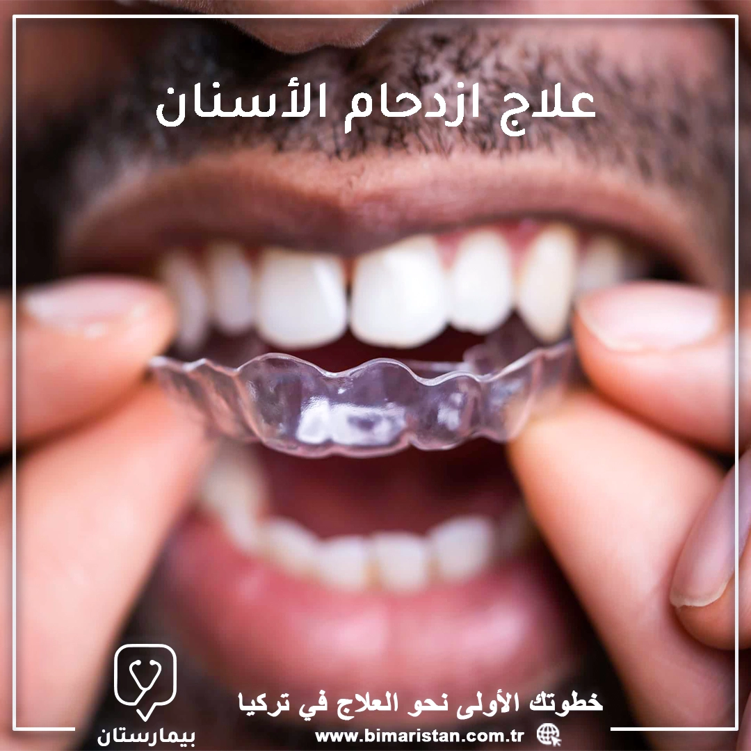 Diş çapraşıklığı tedavisi