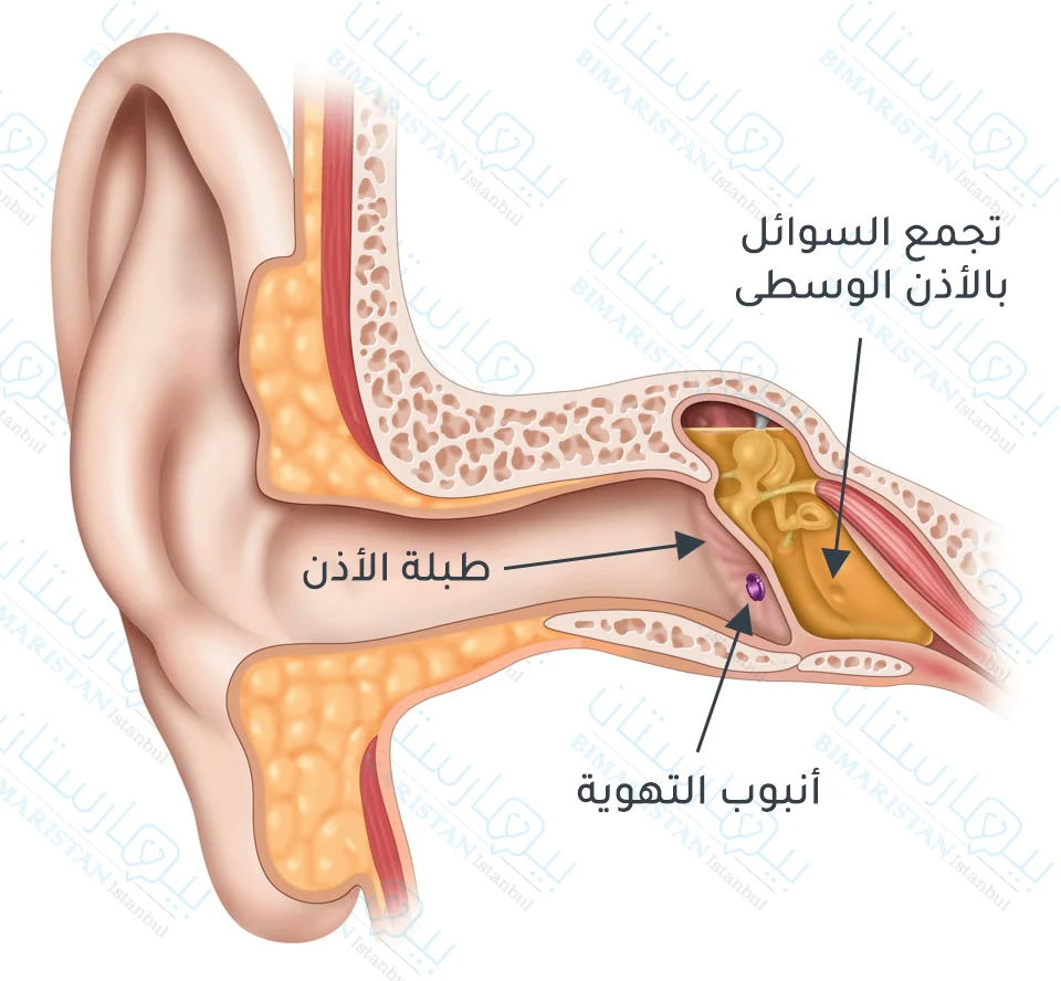 Installation of a ventilation tube to drain fluids and treatment of otitis media for adults