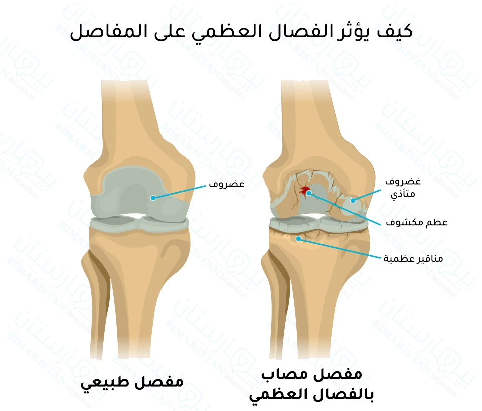 When osteoarthritis occurs, the cartilage is damaged and the bone underneath is exposed, and bony beaks appear in the adjacent bone.