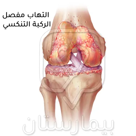 التهاب مفصل الركبة التنكسي (فصال عظمي في الركبة)