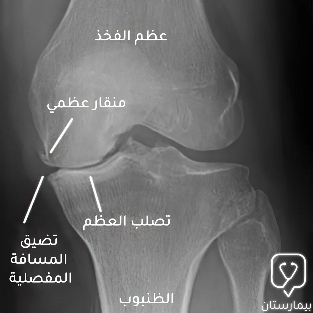 On the radiograph, we notice damage to the articular cartilage in the medial side of the knee joint, narrowing the articular space and forming a bony beak.
