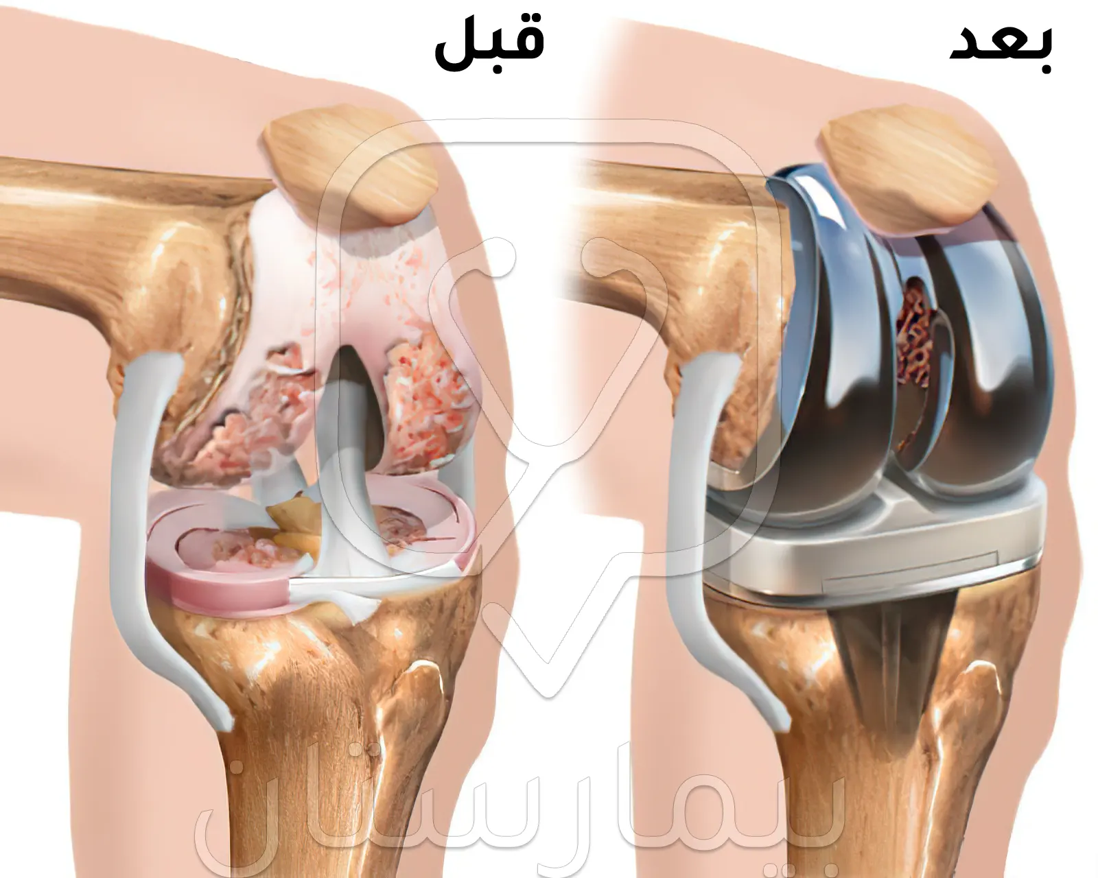 قبل وبعد عملية استبدال مفصل الركبة الكلي